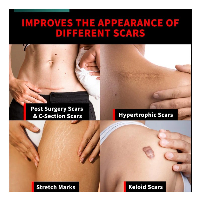 Crema De Silicona Protect Life Para Cicatrices Quirúrgicas,