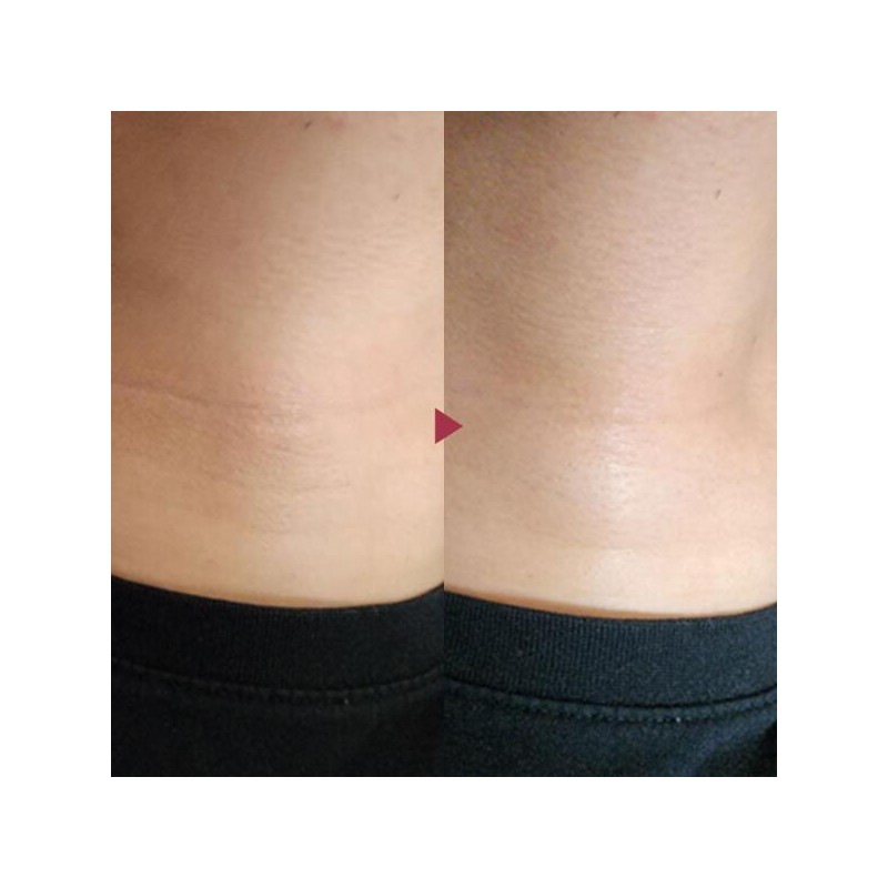 Art Box Anasis Bella Contour Apply Collagen Neck Wrinkle Neck
