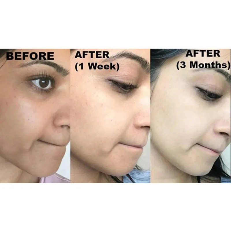 Jabón De Ácido Kójico Y Glutatión 100g No 4 Versión