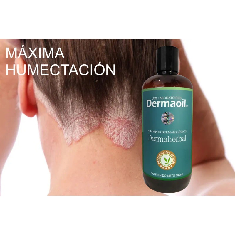 Shampoo Terapéutico Natural Alivio Para Psoriasis Capilar