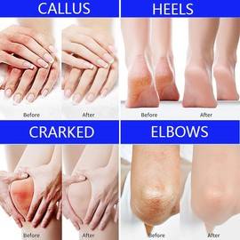 BERVEAL Urea Cream foot cream, 40 percent Foot Care Lotion for Cracked Heels,Moisturizing，Cracked Heels, Ultra,Rough, Dry, Calloused Feet,Softening Rough skin on feet for All Skin 5.29 fl.oz