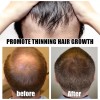 Derma Roller Beard Derma Roller For Hair Loss Beard Growth