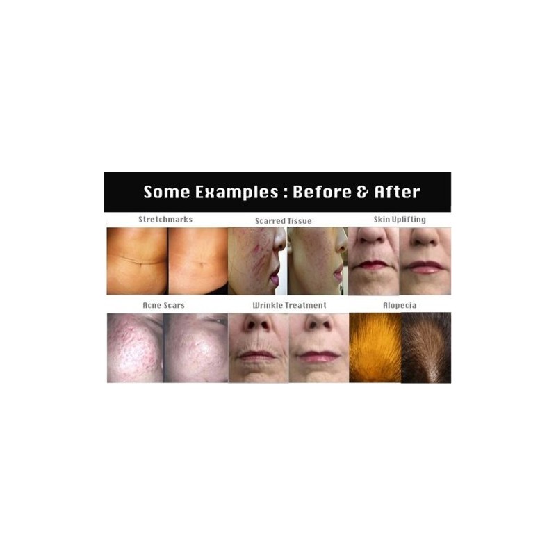 Infinitive Beauty- Micro Nadelroller System2.0mm Professional Titan Mikronade...