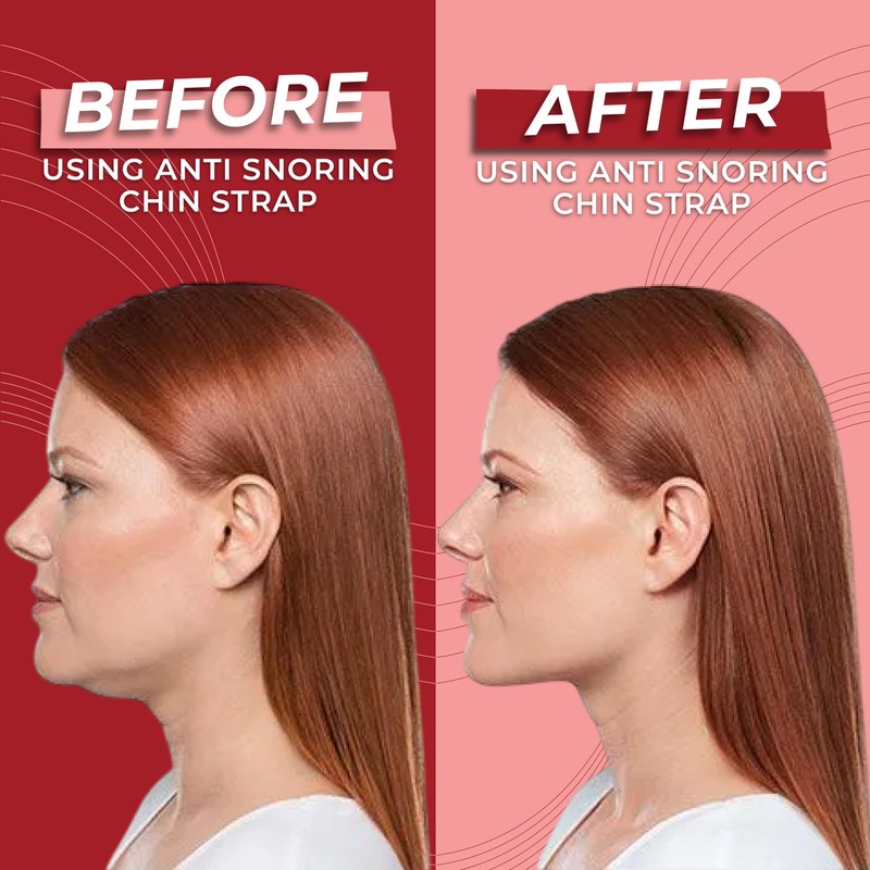 Massner Extra Strength Chin Strap for Sleeping, Breathable, Comfortable CPAP