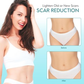 Silikonpflaster Für Narben(4mx4.6cm Rolle), Silikon Narbenpflaster Wiederverwendbar, Rolle Narbenband Perfekt Für Die Kaiserschnittnarbe, Narben Entfernen, Narben Im Gesicht, Keloid, haftet sehr gut