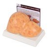 Simedutech Silicone Alcoholic Fatty Liver Model, Pathological Liver Replica for