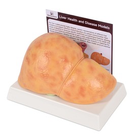 Simedutech Silicone Alcoholic Fatty Liver Model, Pathological Liver Replica for Medical Training & Liver Disease Education