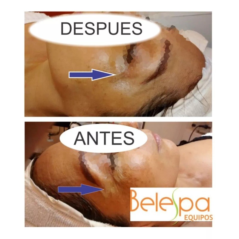 Mychway Mini Hifu Portatil +rejuvenecimiento Facial + Envio Gratis