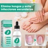 2 Piezas Krassentiales Líquido Reparador de Uñas de Los Pies,
