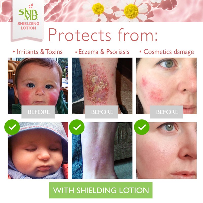 Skin MD Shielding Lotion - 4oz Hydrating Body Lotion for