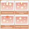 Parches para Acné Estrellas,Estrellas Pimple Patch,Parches Estrellas Acne,Parches Hidrocoloides Absorbentes,