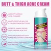 Wonsters 2 x Acne Cream for the Buttocks, Acne Cleansing