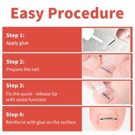 Ingrown Toenail Treatment, 10 packs Titanium Alloy Ingrown Toenail Corrector for all size foot, Ingrown Toenail Removal Kit for Curved Nail Repair, at Home Nail Kit Tools