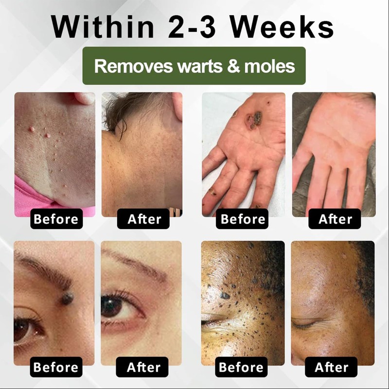 Luhaka Luhaka DermaEase Natureerase Instant Mole Spot Removal Gel,Purifying gel