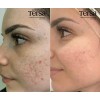 Crema Despigmentante Quita Manchas Acné Paño Vitíligo De 30g