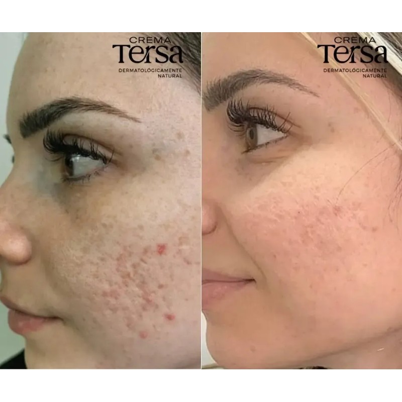 Crema Despigmentante Quita Manchas Acné Paño Vitíligo De 30g