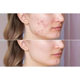 Zaxcell Gel 5g Mejora Acne