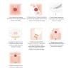Bolsas Para Colostomía Articulos Para Ostomía 20 Pzas