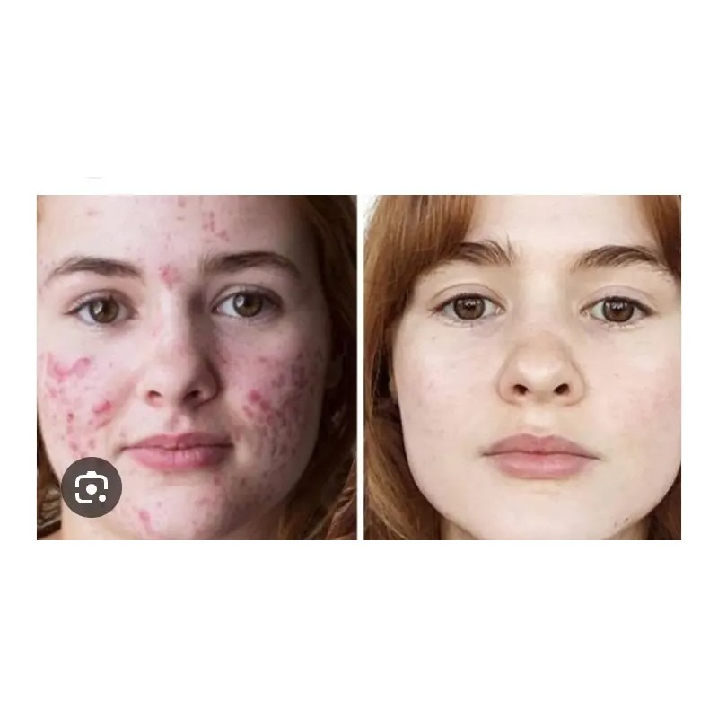 Tratamiento 100% Natural Arrugas Manchas Acne Ojeras Negras