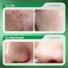 Hydrating Cream 50g - 3% For Zits & Blackhead Improvement,