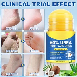60% Urea & 2% Salicylic Acid Foot Stick for Cracked Heels & Calluses | Softens and removes calluses, repairs cracked heels, moisturizes knees, elbows 