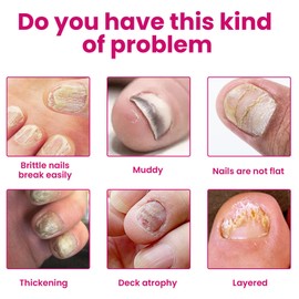 NLFOX Ginger Nail Essence - Nail Support Nail Oil - 10ML Toenail Nail Seurm Extra Strong - Nail Strengthener For Damaged Nails,Nourishing Moisturizing