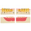 Right Lower Posterior Tooth Model 2X Magnification Detachable Resin Tooth
