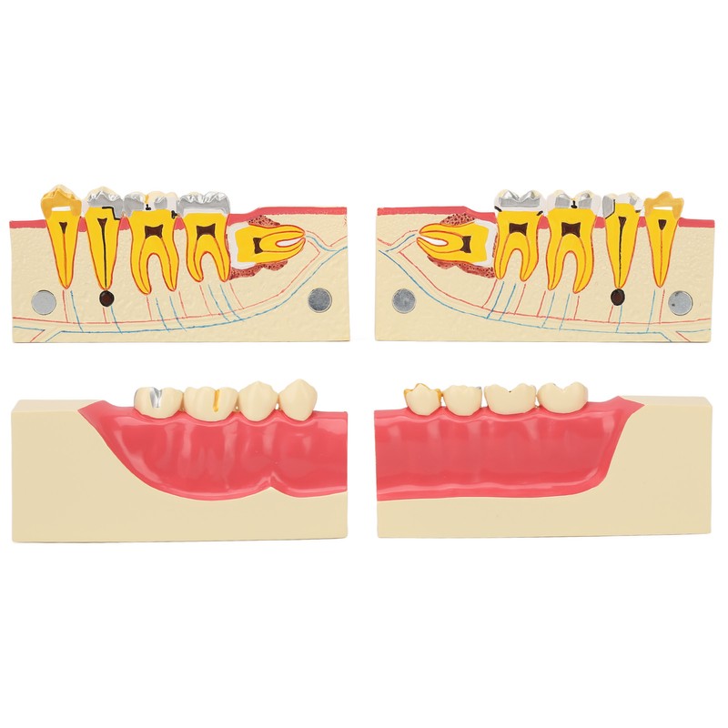 Right Lower Posterior Tooth Model 2X Magnification Detachable Resin Tooth