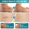 Silicone Scar Sheets, Silicone Scar Tape(1.8” x 157” Roll-4M), Scar