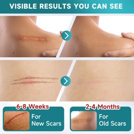 Silicone Scar Sheets, Silicone Scar Tape(1.8” x 157” Roll-4M), Scar Removal Away Strips for Surgical Scars, Keloid, C-Section, Burn et