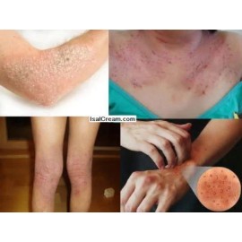 Lote de 3 lociones en crema ISAL Atopy Eczema/Hechas en EE. UU.