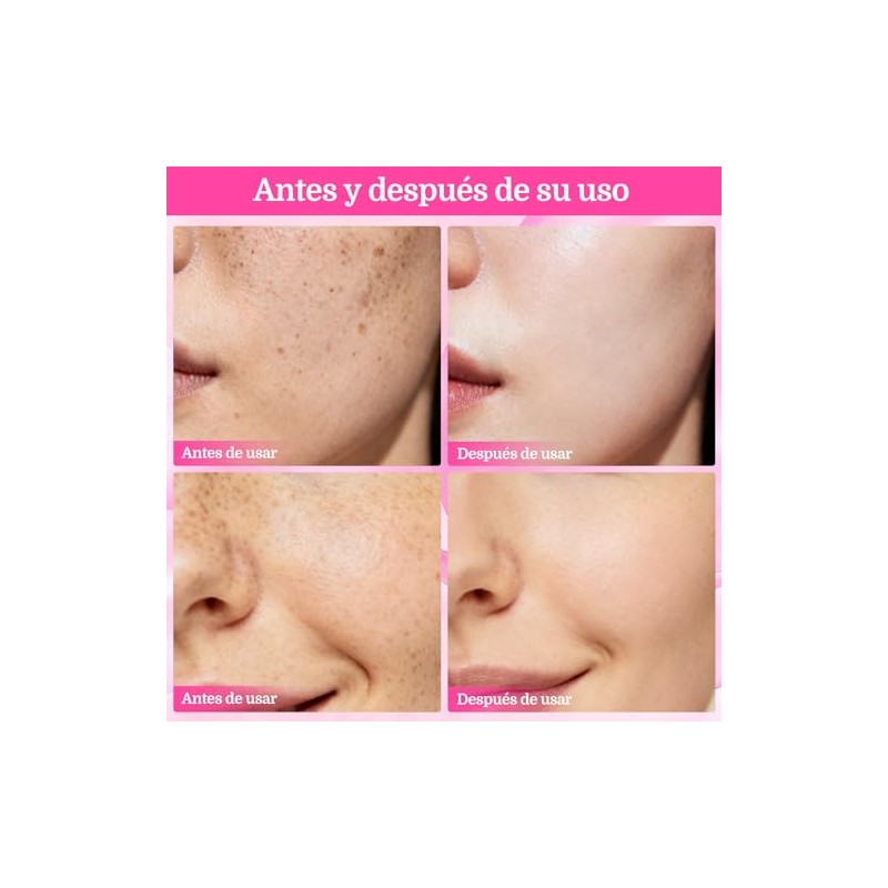 Txa Cream Crema Manchas Faciales Cremas Aclaramiento Piel Oscuras Pecas