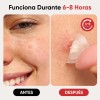 Parches Para Acné Hidrocoloide, Anti Acne Espinillas Granos