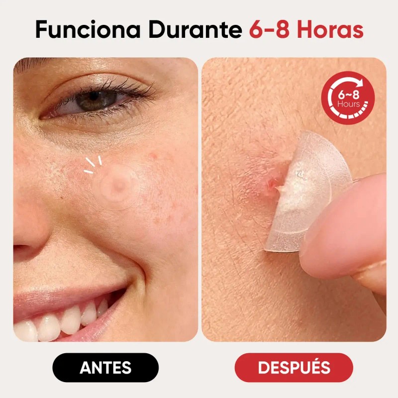 Parches Para Acné Hidrocoloide, Anti Acne Espinillas Granos