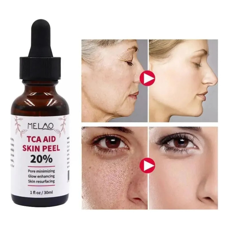 . 30 Ml De Tca Aid Exfoliante Para La Piel,