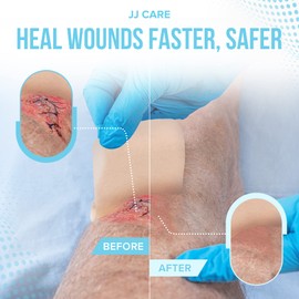 JJ CARE Hydrocolloid Dressing 2x2 [Pack 10], Hydrocolloid Bandages with Border, Self-Adhesive Thin Hydrocolloid Wound Dressing, Wound Care Bandages for Bedsores, Blisters, and Acne