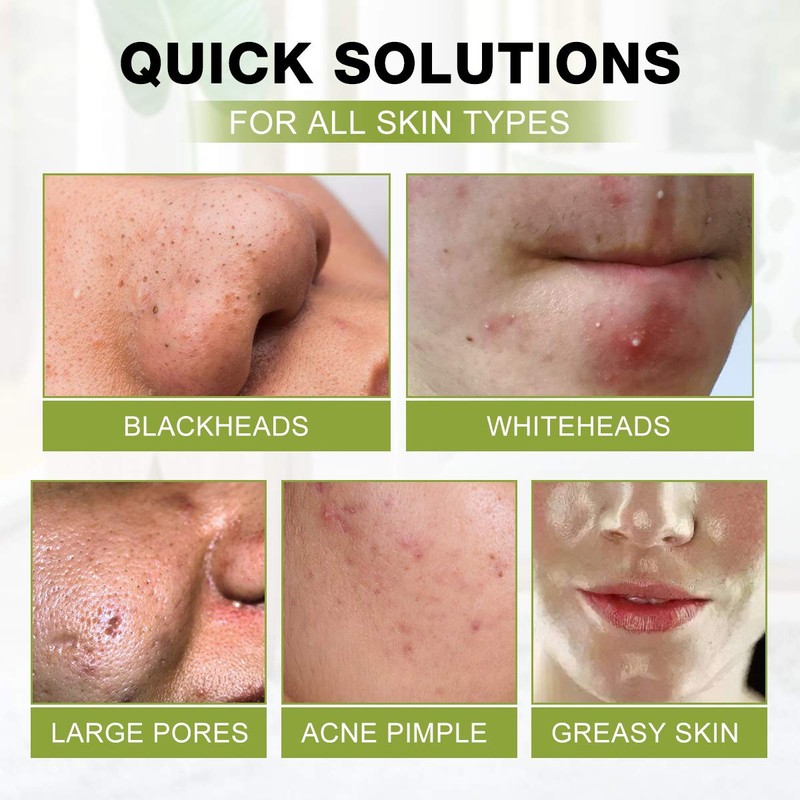 SHVYOG Blackhead Peel Off Face Mask, 3-in-1 Blackhead Remover Mask