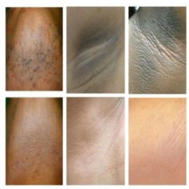 Derma Clinicals Dark Skin Whitening Dark spot  Brightening Bleaching Lightening Face body Cream