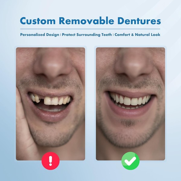 Partial Dentures - Custom Removable Personalized Tooth Replacement Set for
