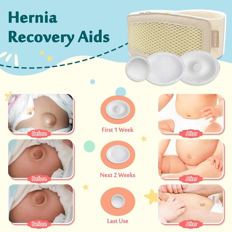 Mybow Umbilical Hernia Belt Baby, Infant Belly Button Band, Umbilical