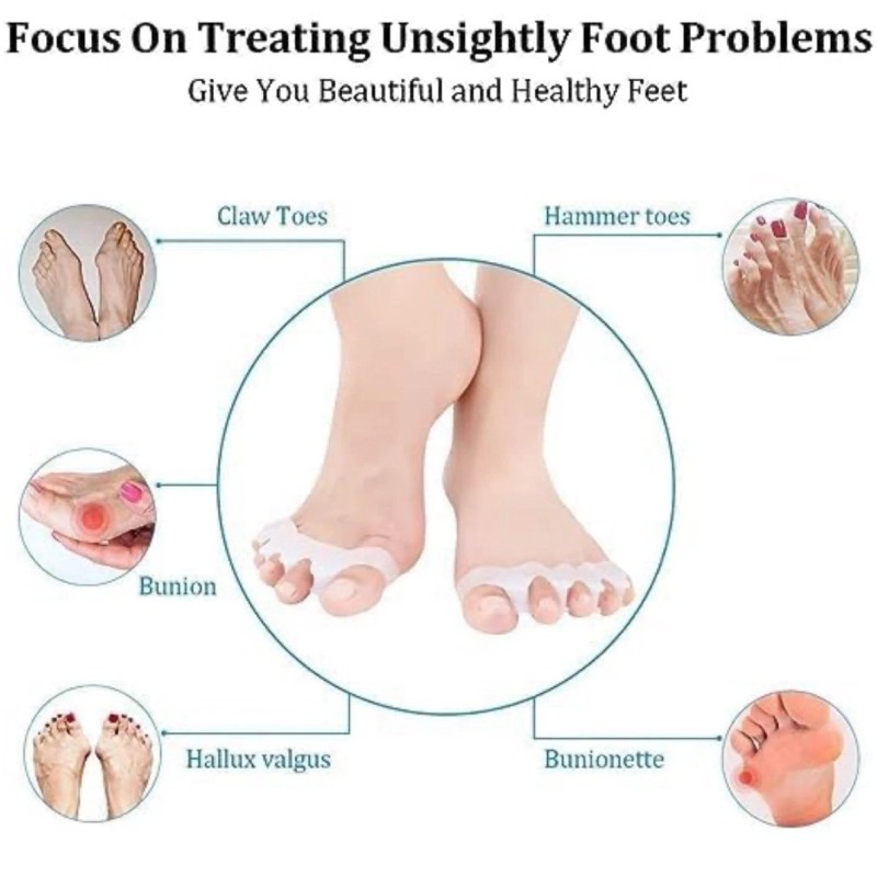 Does Not Apply Toe Separators: Correcting Bunions and Restoring Toes