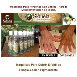 Skinela Loción Maquillaje Pigmentador P Vitiligo 2 Frascos                                                                                            