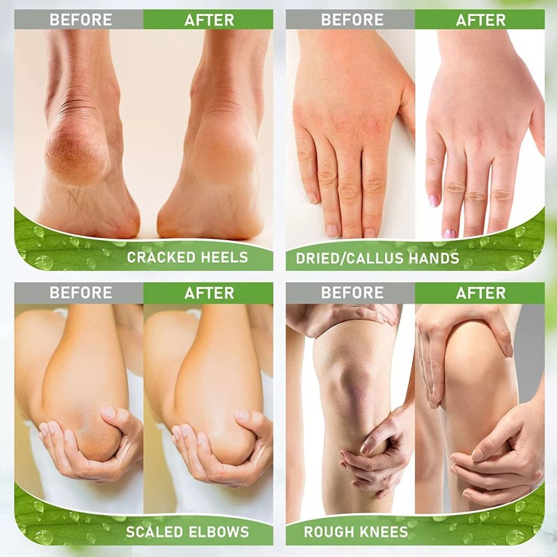 Callus and Dead Skin Remover Crema Para Callos del Pie