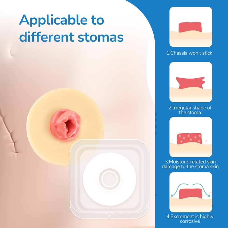 Heagimed 10Pcs 2mm Moldable Ostomy Rings, Hydrocolloid Stoma Barrier Rings