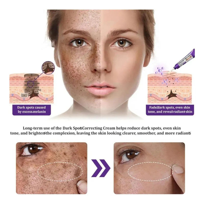 Crema Epiglow Melanex Antihiperpigmentante Avanzada,