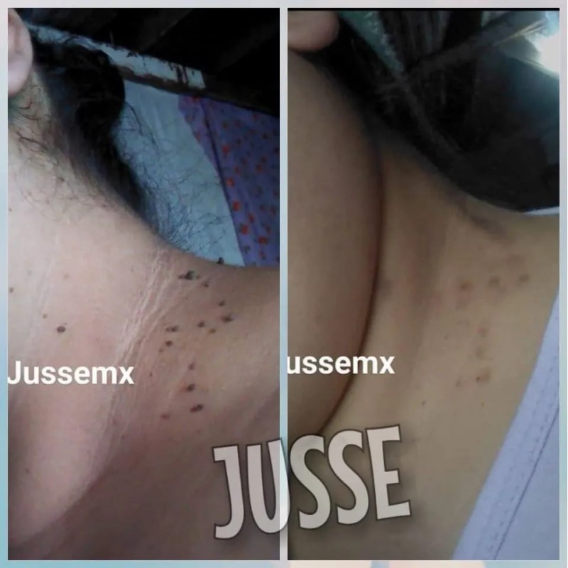 Jusse Anti Verrugas Lunares Mezquinos 15 Ml Sin Perfumar