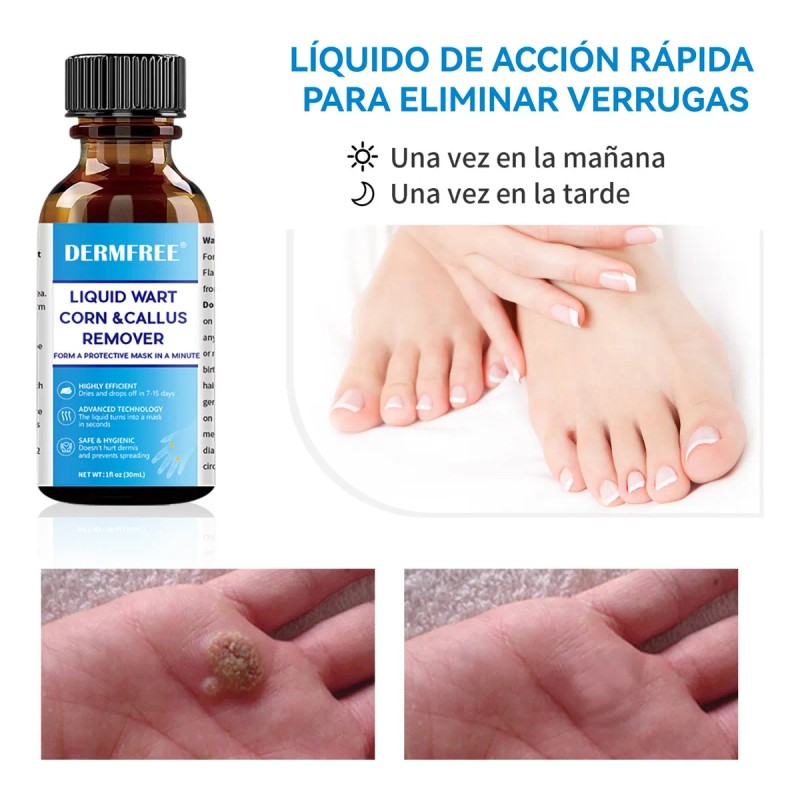 Líquida Eliminación De Verrugas,verrugas Plantare Y Comune