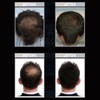 Hair Growth Light Hat Hair Treatment USB Lamp Hat For