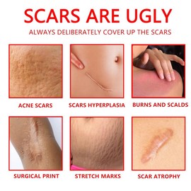 Professional Scar Removal Gel – Effective Treatment for Post-Operative, C-Section, Keloid, Burn & Acne Scars