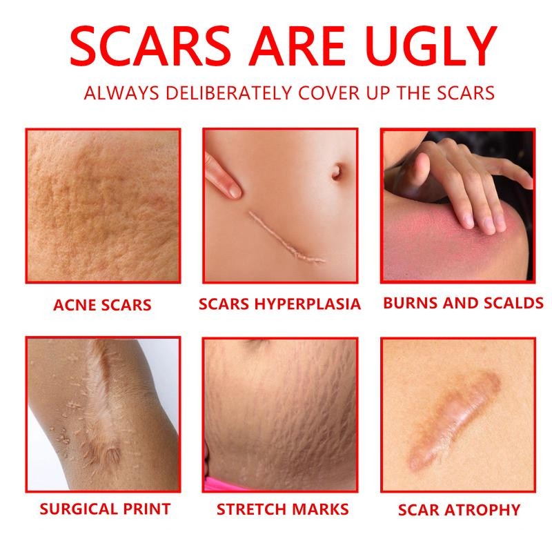 Professional Scar Removal Gel – Effective Treatment for Post-Operative, C-Section,